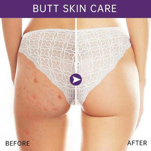 Butt Body Acne Whitening Cream Acne Clearing Spot Treatment