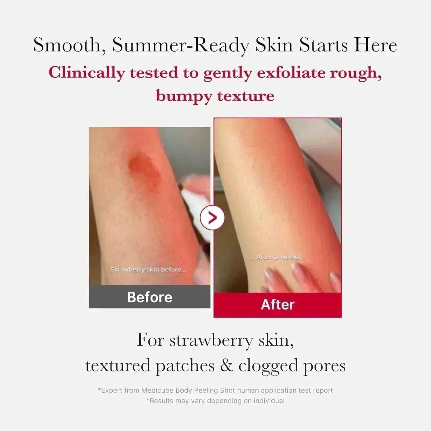 Red Acne Body Peeling Shot | 🌸 مقشر ميديكيوب الكوري لعلاج حبوب الجسم