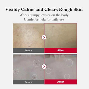 Red Acne Body Peeling Shot | 🌸 مقشر ميديكيوب الكوري لعلاج حبوب الجسم