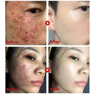 Blackhead Remover Face Mask Cream for deep pore cleansing and blackhead removal