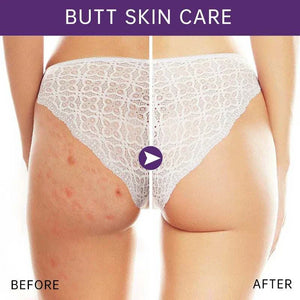 Butt Body Acne Whitening Cream Acne Clearing Spot Treatment