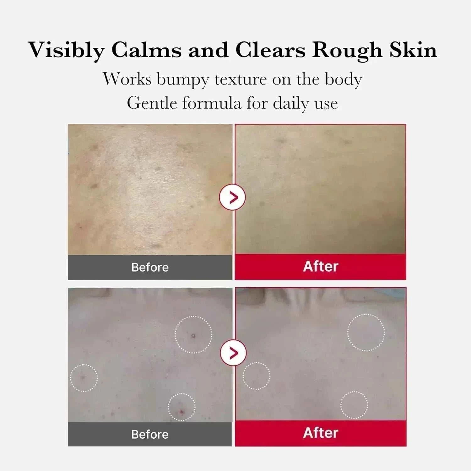 Red Acne Body Peeling Shot | 🌸 مقشر ميديكيوب الكوري لعلاج حبوب الجسم