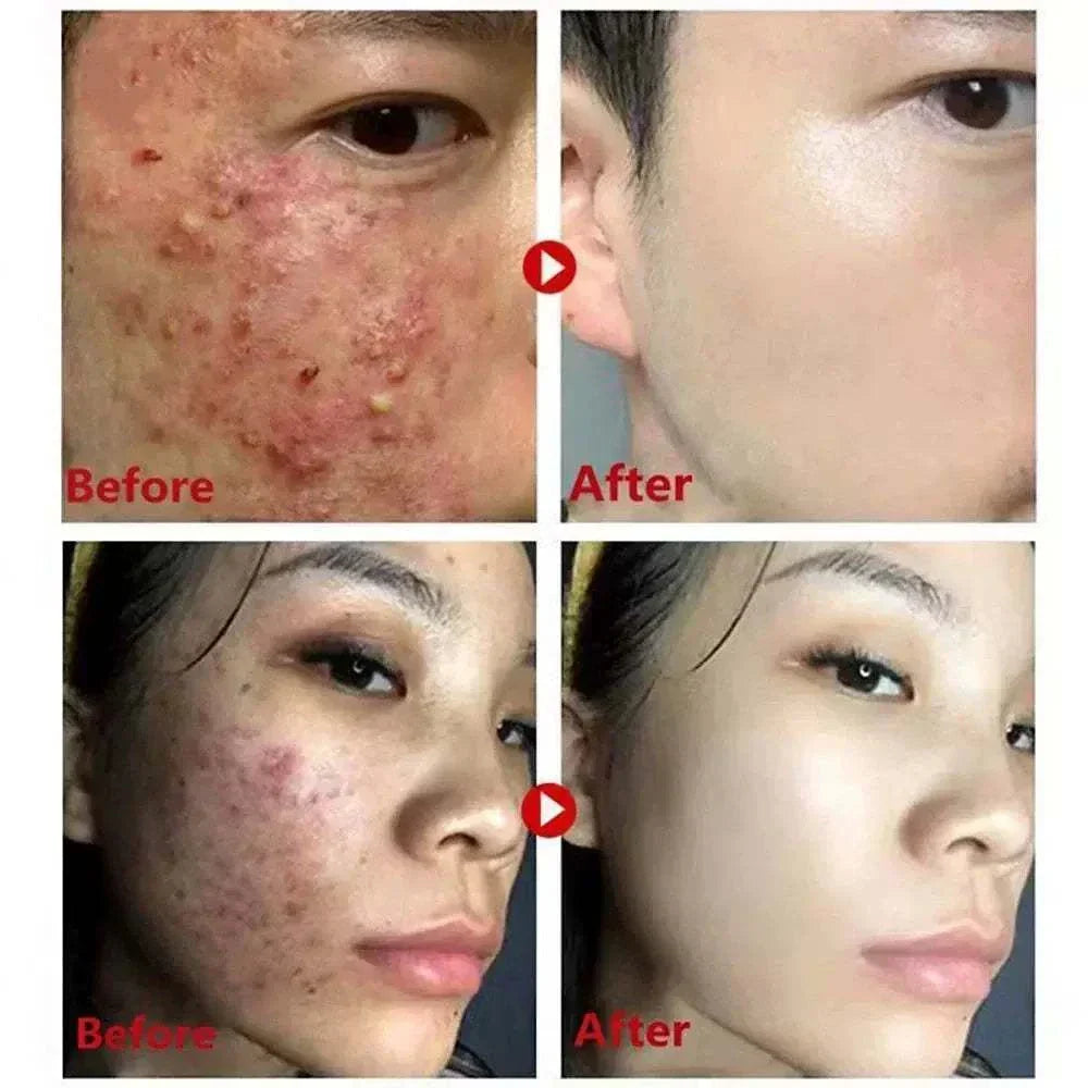 Blackhead Remover Face Mask Cream for deep pore cleansing and blackhead removal