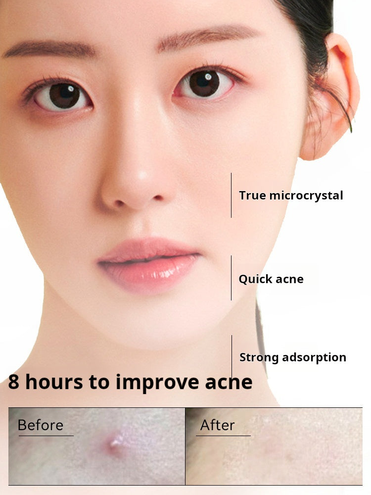 Korean Daxiong Pharmaceutical Magnesium Microcrystal Acne Patch, Acne Removal Patch, Invisible Concealer, Acne Scar Emergency Patch, 6 pieces